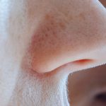 Rhinoplasty San Diego