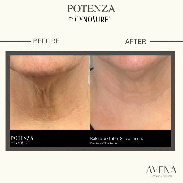 Microneedling in San Diego - Avena Natural Health Before and After