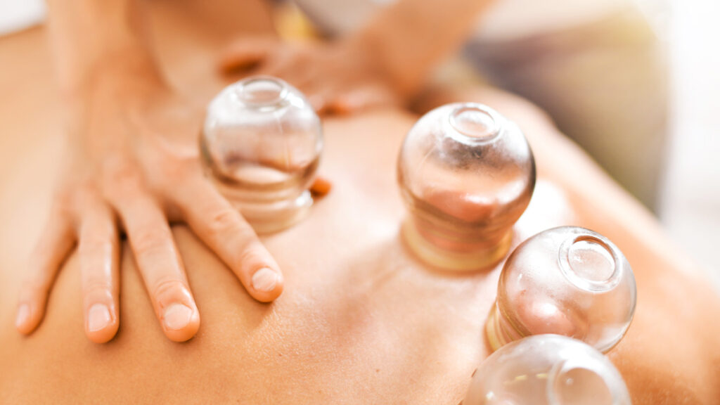 Find a Naturopath Doctor in La Jolla - cupping therapy